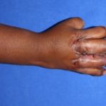 ಕೂಡಿಕೊಂಡ ಕೈಗಳನ್ನು ಬೇರ್ಪಡಿಸಿದ ವೈದ್ಯರು